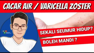 Virus Varicella Mengancam? Hanya 4 Prosedur Wajib Ini Bisa Mencegah Cacar Air Secara Total!