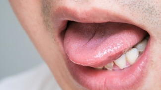 Lidah Pahit Bikin Nafsu Makan Hilang? Ini 5 Penyebab dan Cara Mengatasinya