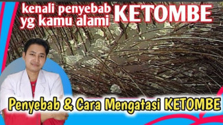 Gak Hanya Malas Keramas! Ini Biang Kerok Jamur dan Trik Jitu Atasi Ketombe Permanen!