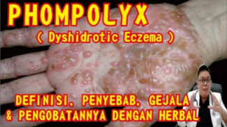 Tangan & Kaki Gatal Berlepuh? Kenali Dyshidrotic Eczema dan Cara Alaminya!