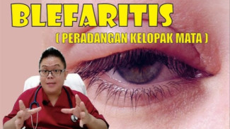 Kelopak Mata Bengkak dan Gatal? Waspadai Blefaritis, Peradangan Sepele yang Bisa Bikin Bulu Mata Rontok!