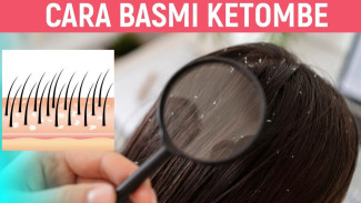 Rahasia Rambut Bebas Ketombe! 9 Bahan Alami Ini Bisa Bikin Kulit Kepala Sehat dan Rambut Mengkilap