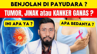 Benjolan di Payudara Belum Tentu Kanker, Ini 5 Tanda yang Harus Diwaspadai