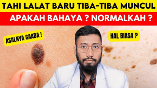 Tahi Lalat Muncul Tiba-Tiba? Ini 5 Penyebabnya dan Tanda Bahaya yang Harus Diwaspadai