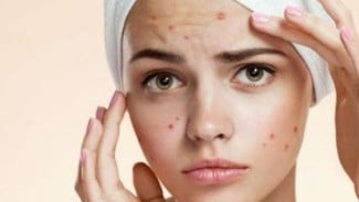 7 Bahan Alami yang Bisa Mengatasi Jerawat, Nomor 3 Jarang Disangka!