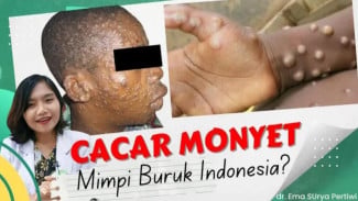 Monkeypox Masuk Indonesia! Kenali Gejala, Cara Penularan, dan Bedanya dengan Cacar Air