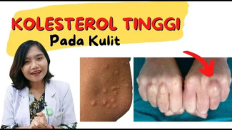 Jangan Kaget! Kenali Bintik Kuning Kolesterol di Kelopak Mata dan Kulit, Tanda Kadar Lemak Darah Melonjak!