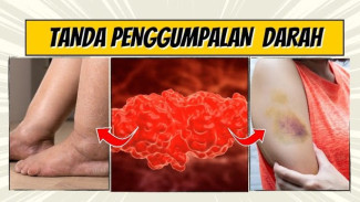 Hati-Hati Tanda Penggumpalan Darah Ini Bisa Fatal, Kenali Gejalanya Sekarang!