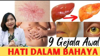 Bukan Gerd Biasa! Waspada 9 Tanda Bahaya Penyakit Hati Berlemak Non-Alkoholik (NAFLD)