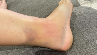 Jangan Cuekin Kaki Kamu! 2 Tanda Sepele Ini Bisa Jadi Peringatan Awal Serangan Jantung!