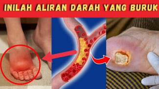 Sirkulasi Darah Anda Bermasalah? Kenali 8 Gejala dan Penyebabnya Sebelum Fatal