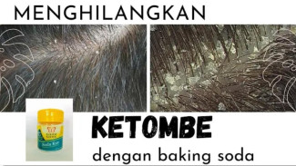 Bye Bye Ketombe! Tutorial Praktis Hilangkan Ketombe Alami dengan Baking Soda dan Minyak Zaitun