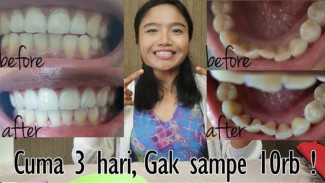 Gigi Putih Alami! 2 Rahasia Rumahan Ampuh Rontokkan Karang Gigi Membandel