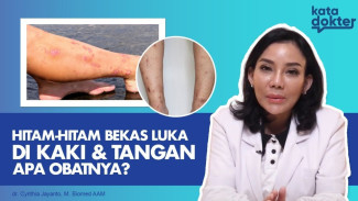 Bekas Luka Hitam di Kaki dan Tangan Bikin Minder? Begini Cara Menghilangkannya