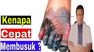 Luka Diabetes Meledak dan Membusuk? Ini Rahasia Jitu Menghentikan Penyebarannya Sekarang Juga