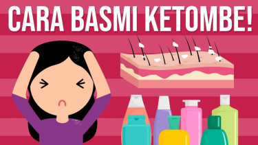 Ilustrasi cara membasmi ketombe