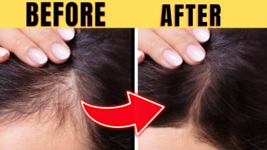 Tips mengatasi kerontokan rambut