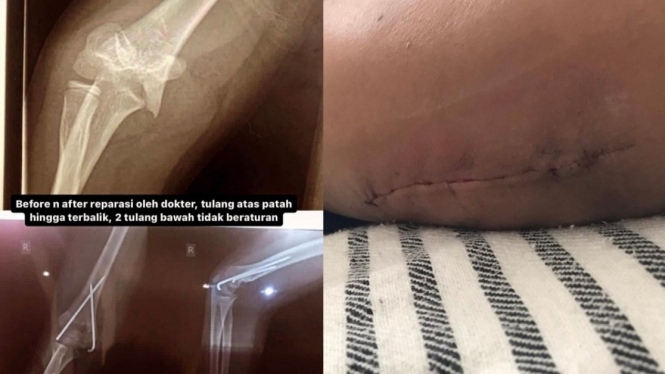 Siswa SD Sukabumi korban bullying