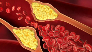 Benarkah Semua Lemak Bikin Kolesterol Naik? Fakta Medis yang Mengejutkan