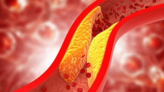Benarkah Kolesterol Tinggi Selalu Berbahaya? Begini Kata Dokter