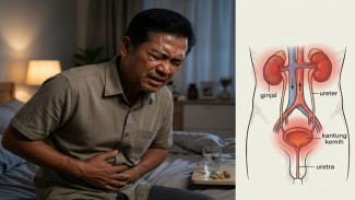 Batu Ginjal Kerap Dipicu Kurang Minum Banyak Menyerang Usia Produktif