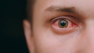 Bahaya! Ini 4 Penyakit Kelamin yang Menyerang Mata