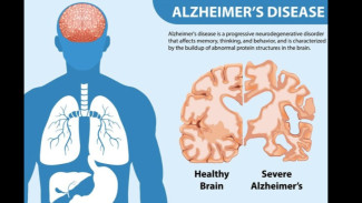 Pilihan Makanan dan Gaya Hidup yang Dapat Menurunkan Risiko Alzheimer