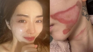 Mimpi Karier Terhenti, Kwon Mina Alami Luka Parah Usai Perawatan Kulit