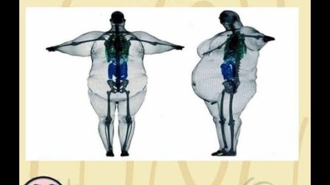 Ilustrasi gemuk karena tulang besar