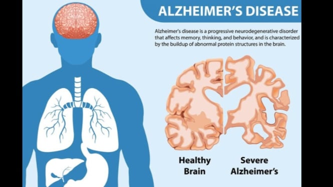 Ilustrasi alzheimer (freepik.com)