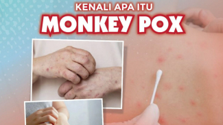 Cacar Monyet Menular dari Hewan ke Manusia Lewat Cakaran/Gigitan Hewan Cacar Monyet Menular dari Hewan ke Manusia Lewat Cakaran/Gigitan Hewan