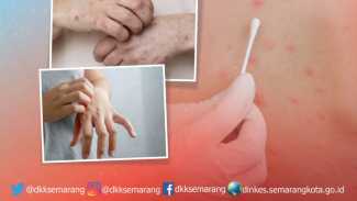 Cacar Monyet Menular dari Hewan ke Manusia Lewat Cakaran/Gigitan Hewan Cacar Monyet Menular dari Hewan ke Manusia Lewat Cakaran/Gigitan Hewan