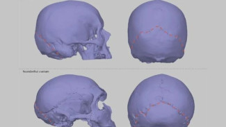 Gen Neanderthal Mungkin Menjelaskan Kelainan di Mana otak Menonjol Keluar dari Tengkorak