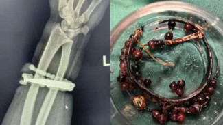 10 Tahun Terkunci, Gelang Cantik Ini Nyaris Merenggut Nyawa Wanita, Infeksi Mengerikan Mengancam