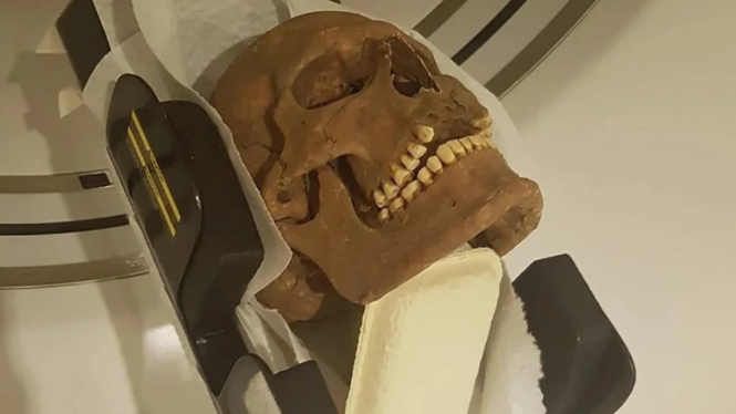 Tengkorak dipasang di CT-scanner