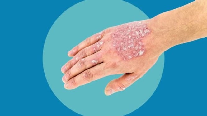 Kulit yang Mengalami Psoriasis