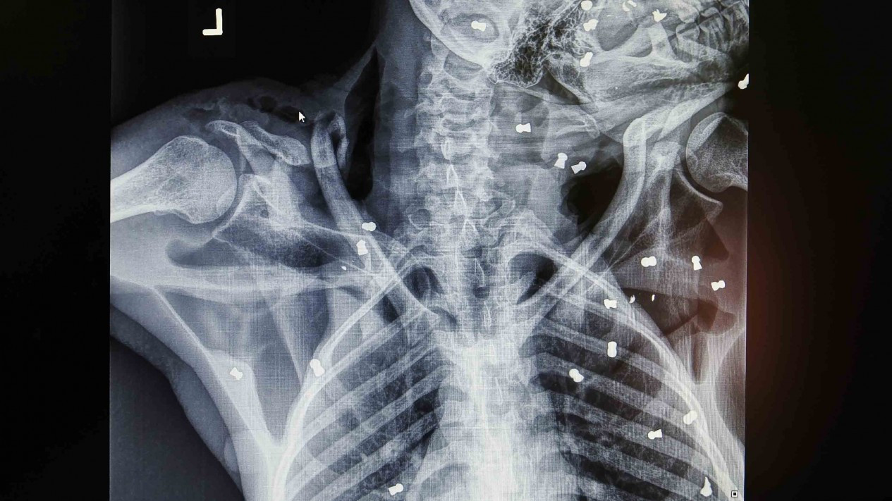 Kondisi Orangutan yang Diberondong Tembakan