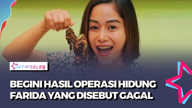 Operasi Hidung Ketiga Gagal, Farida Nurhan Diminta Bersyukur